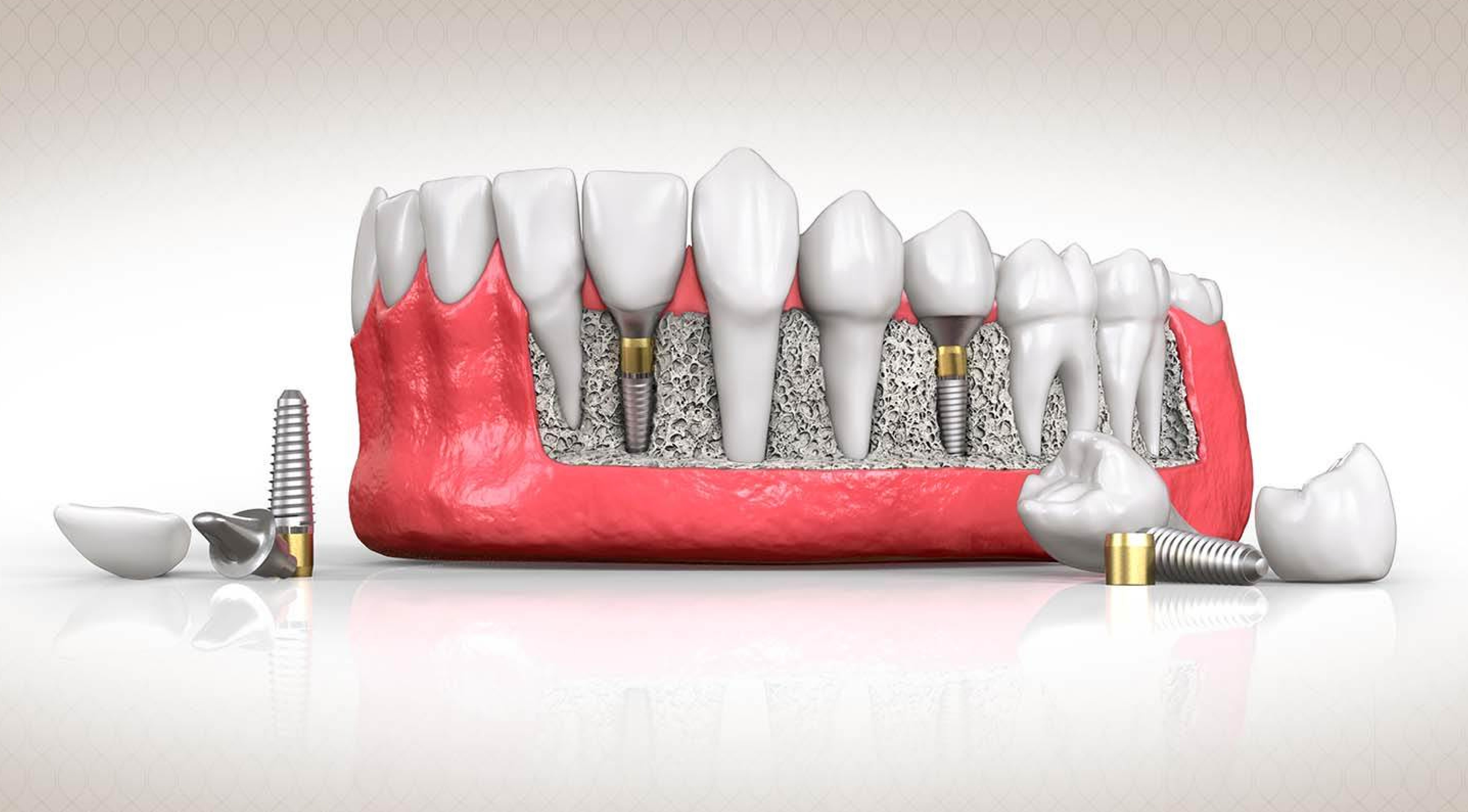 زراعة الاسنان