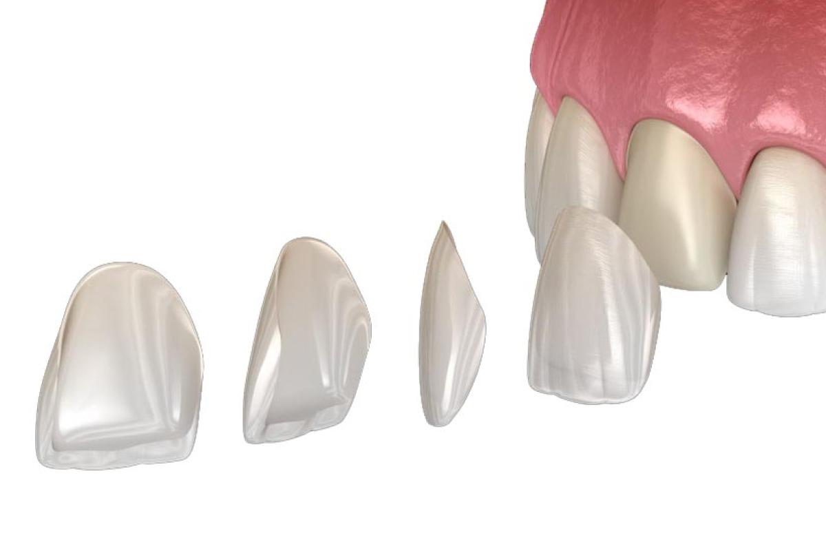 قشور خزفية رقمية