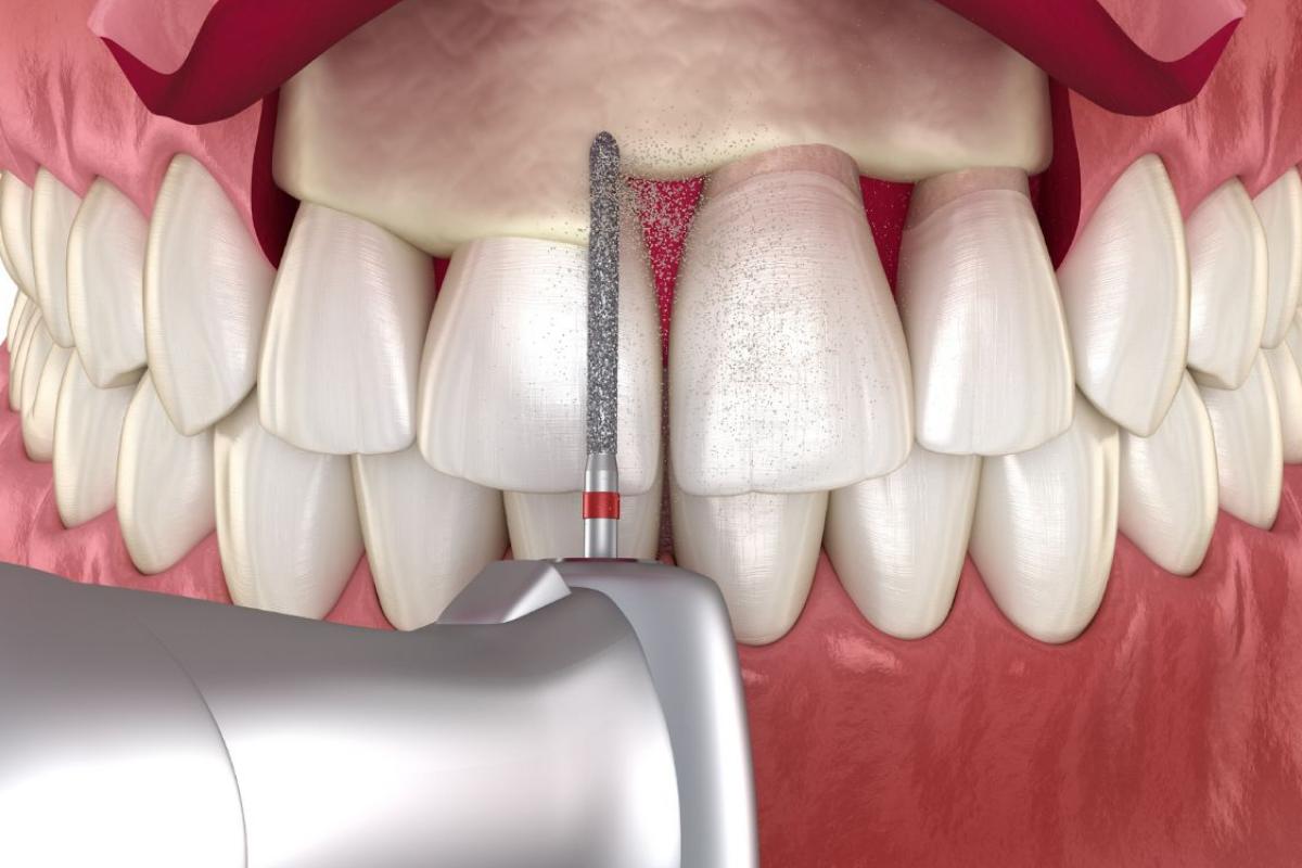 اطالة التيجان