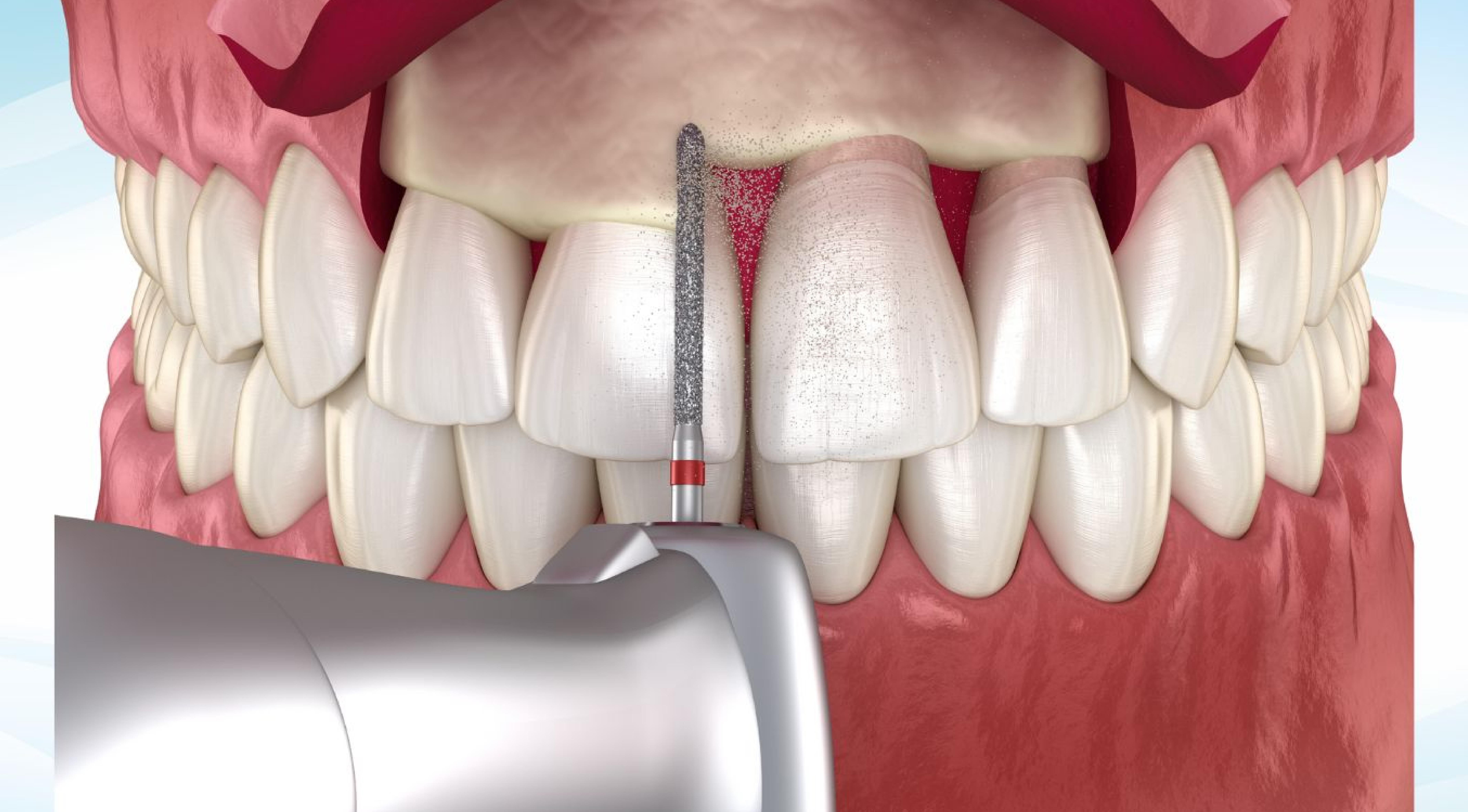 اطالة التيجان