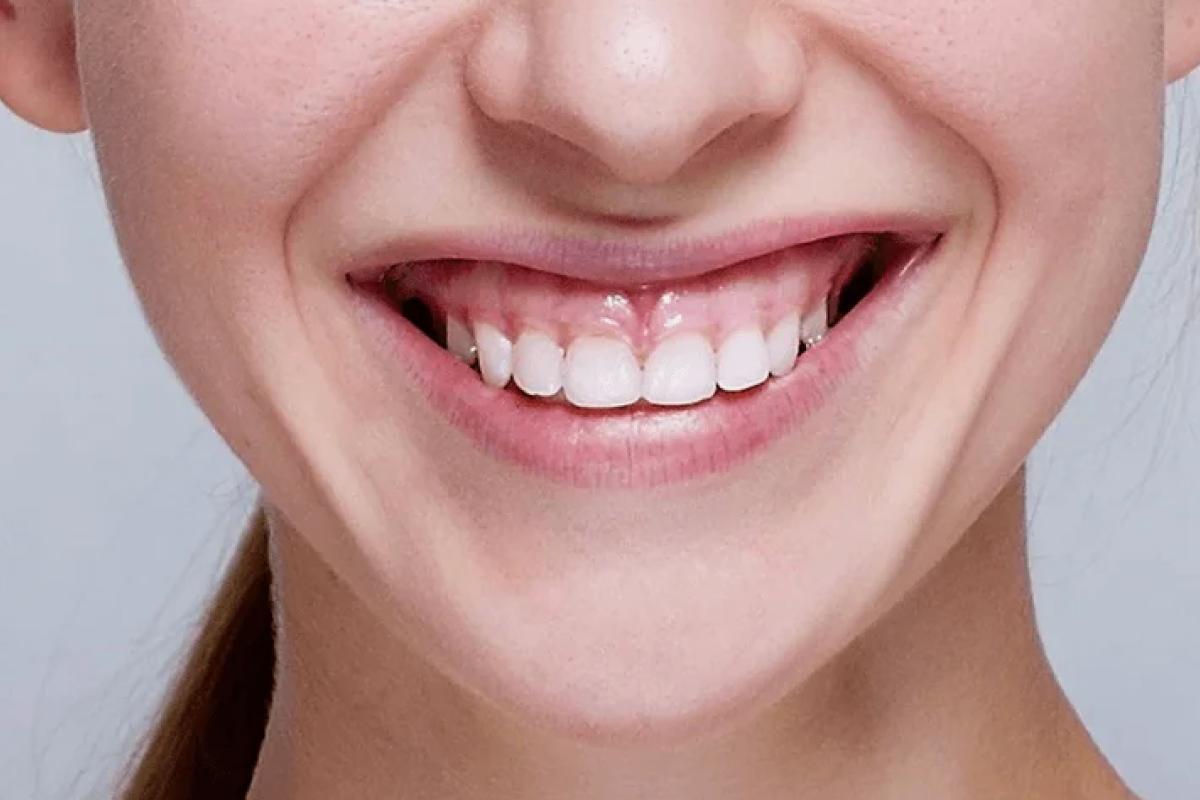 تصحيح الابتسامة اللثوية