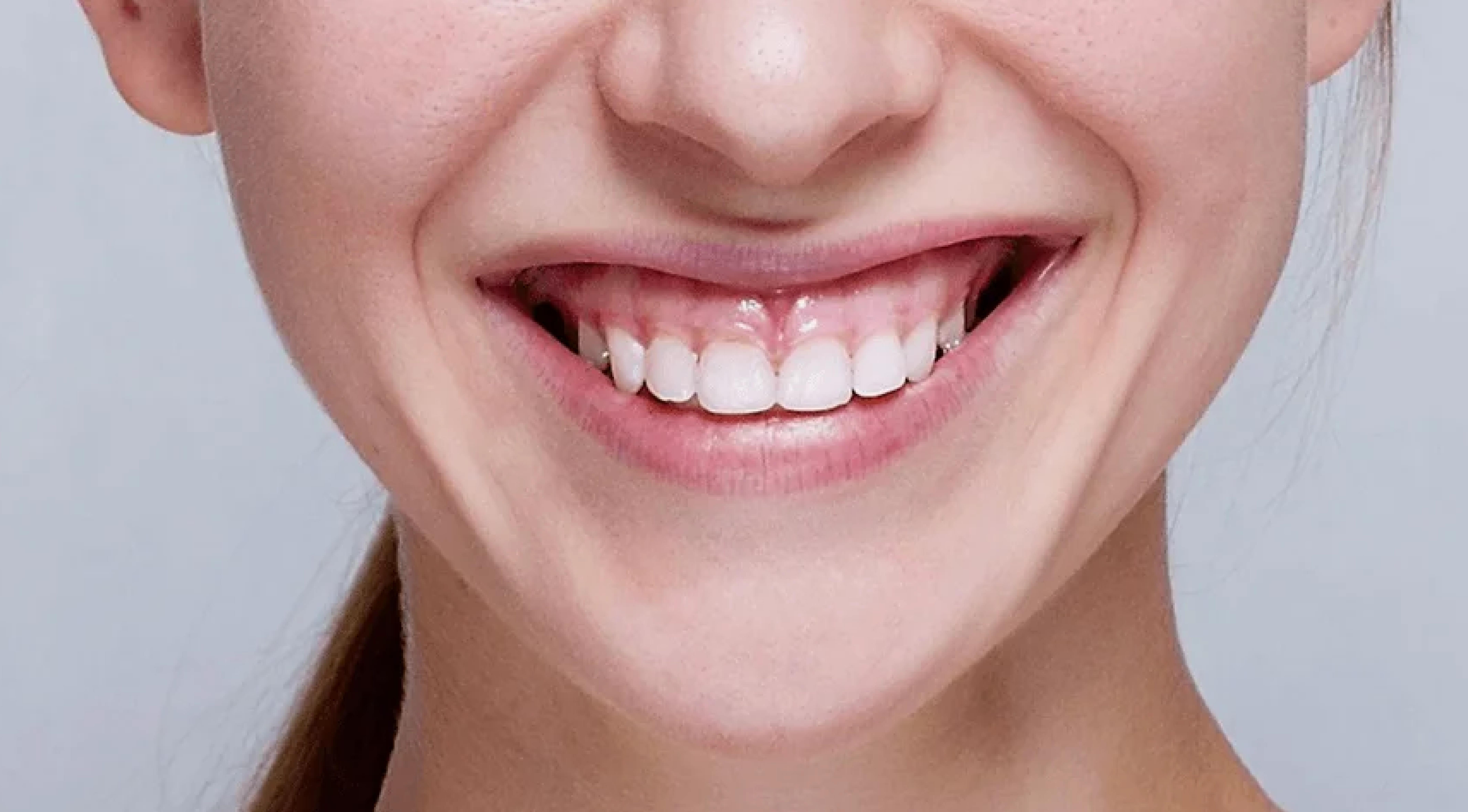 تصحيح الابتسامة اللثوية