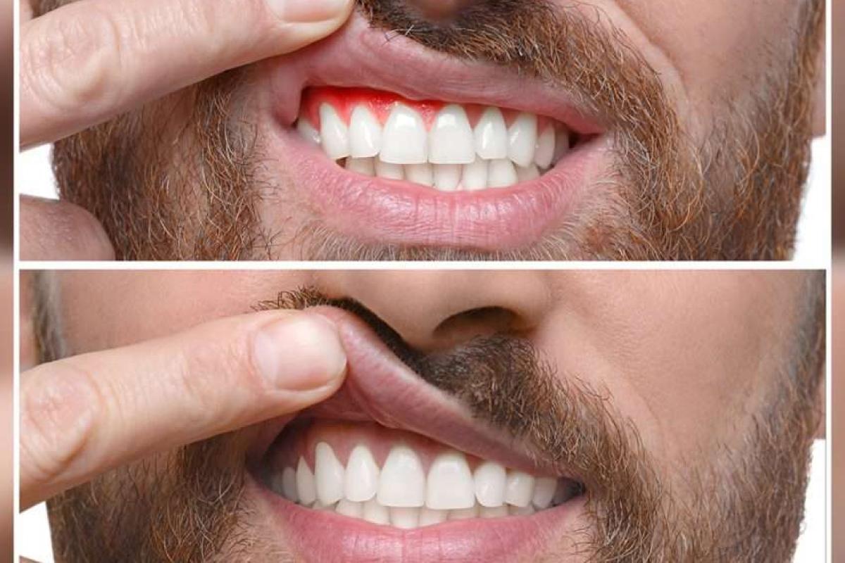 توريد اللثة