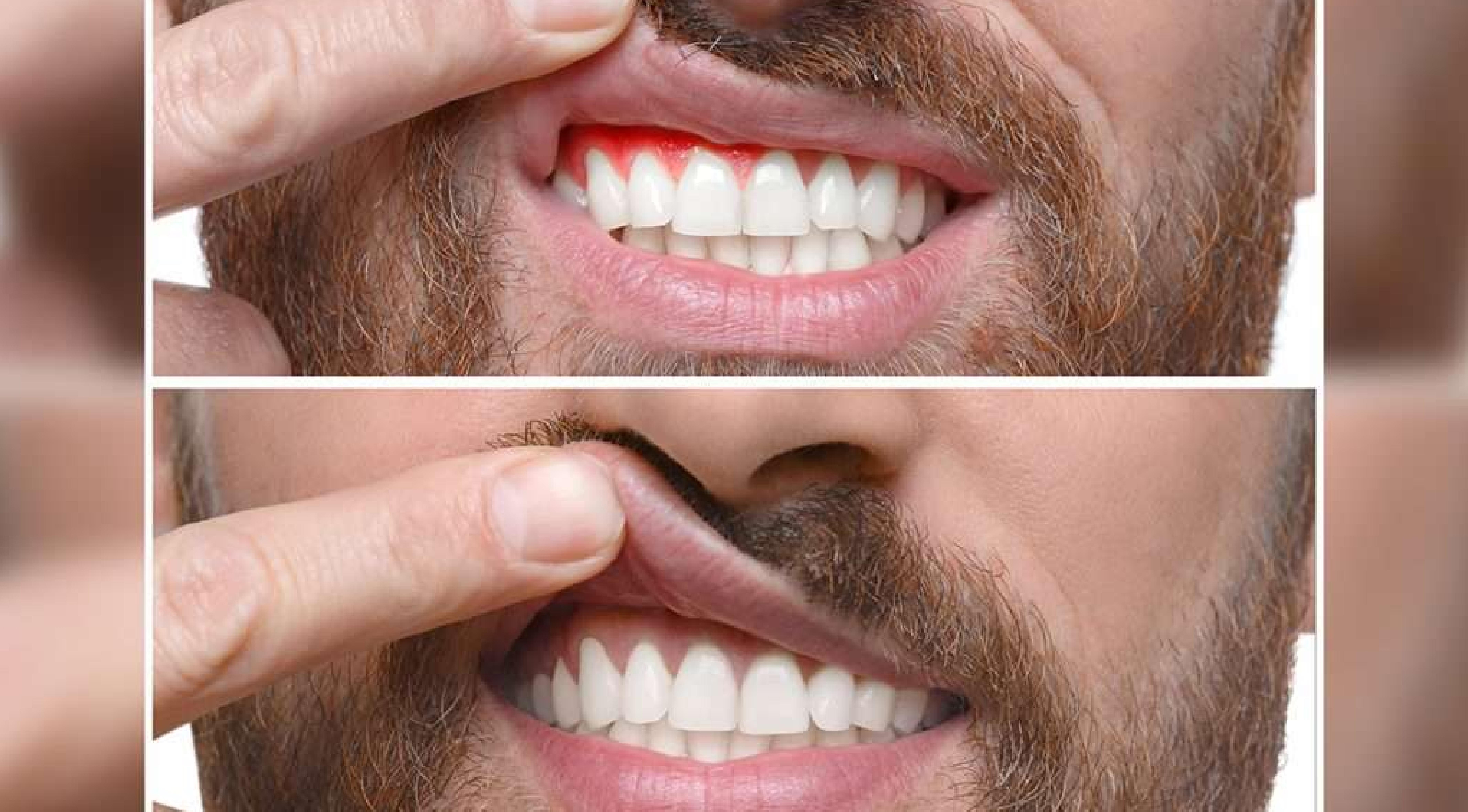 توريد اللثة