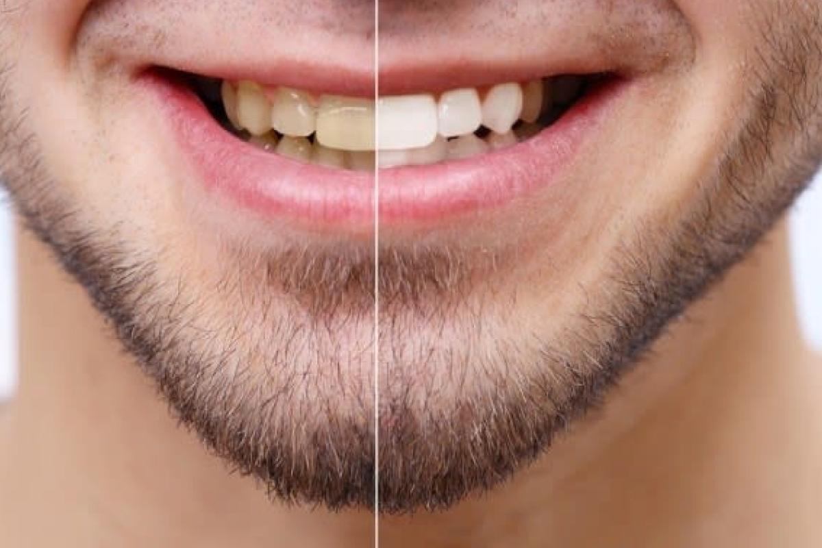 تبييض الاسنان