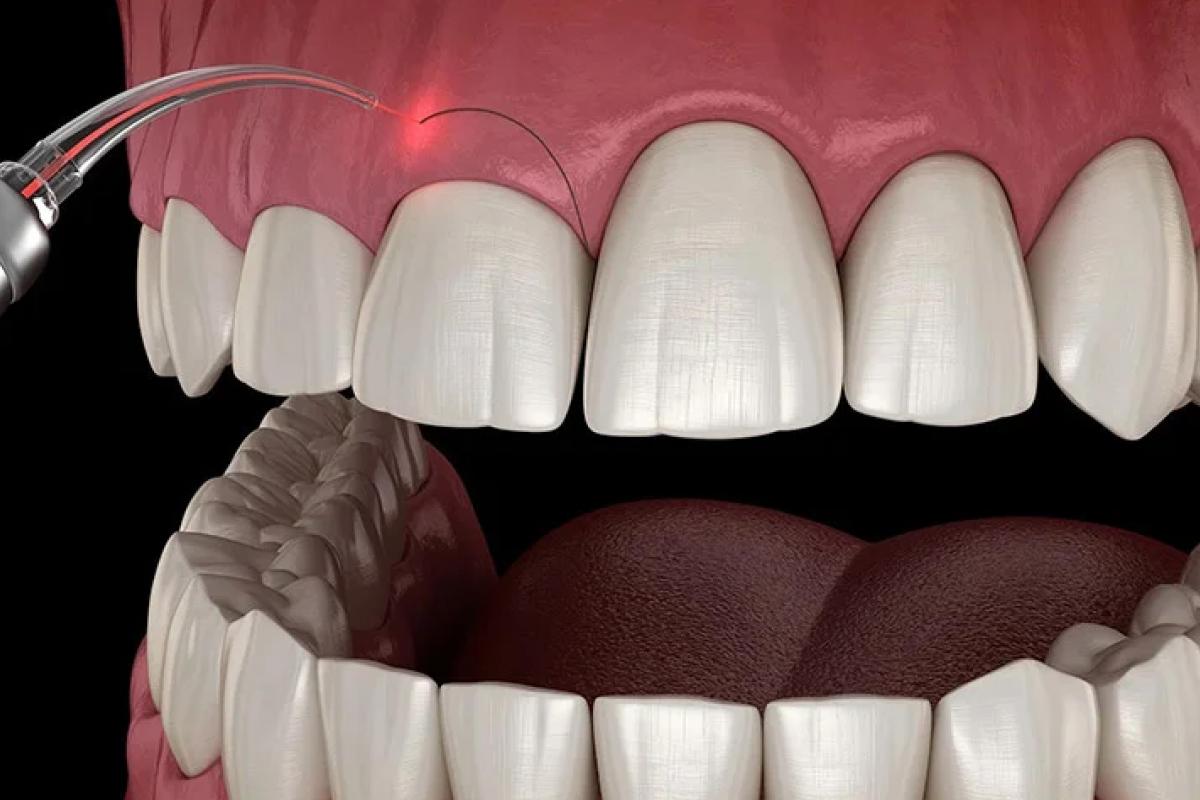 جراحة اللثة وتجميلها