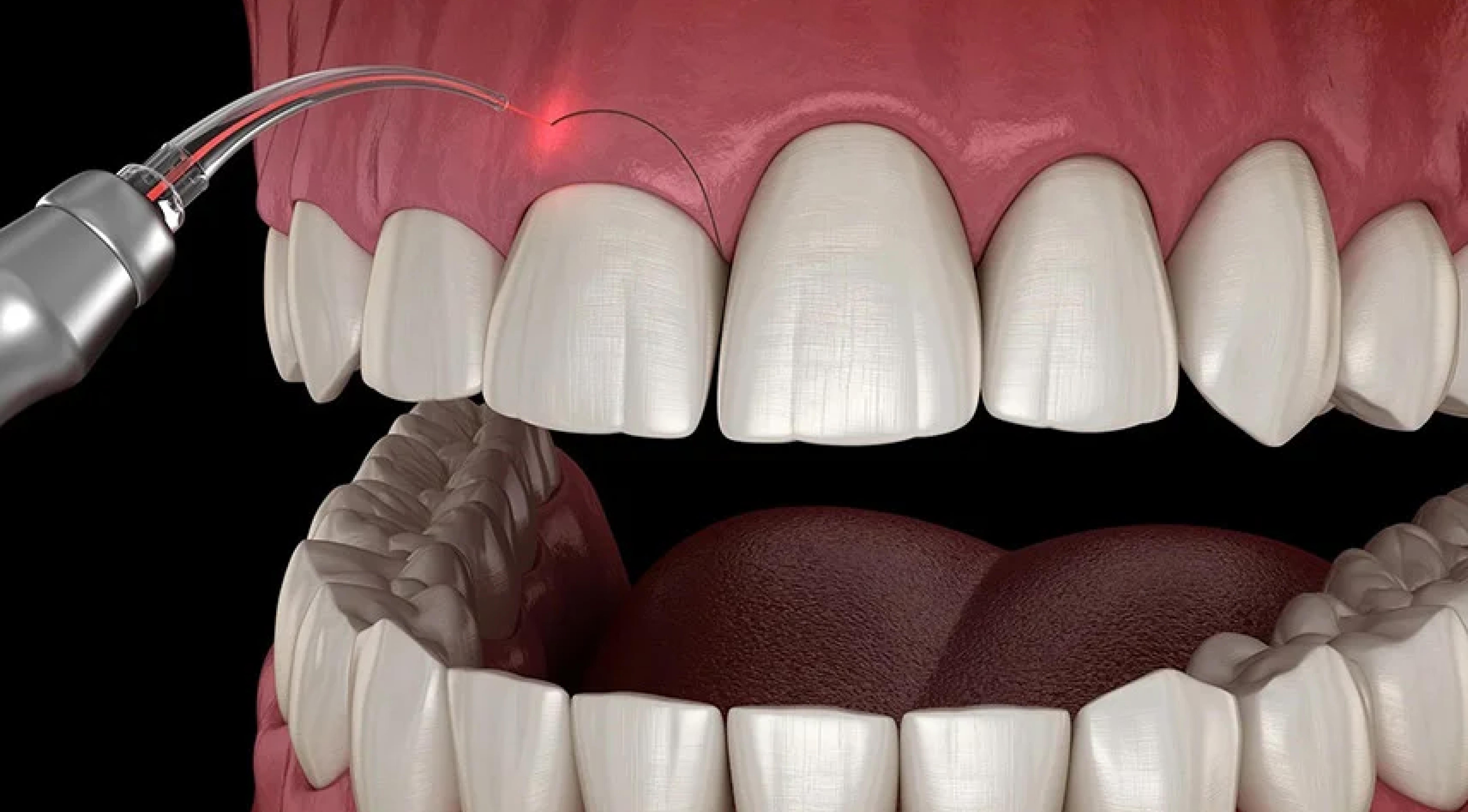 جراحة اللثة وتجميلها