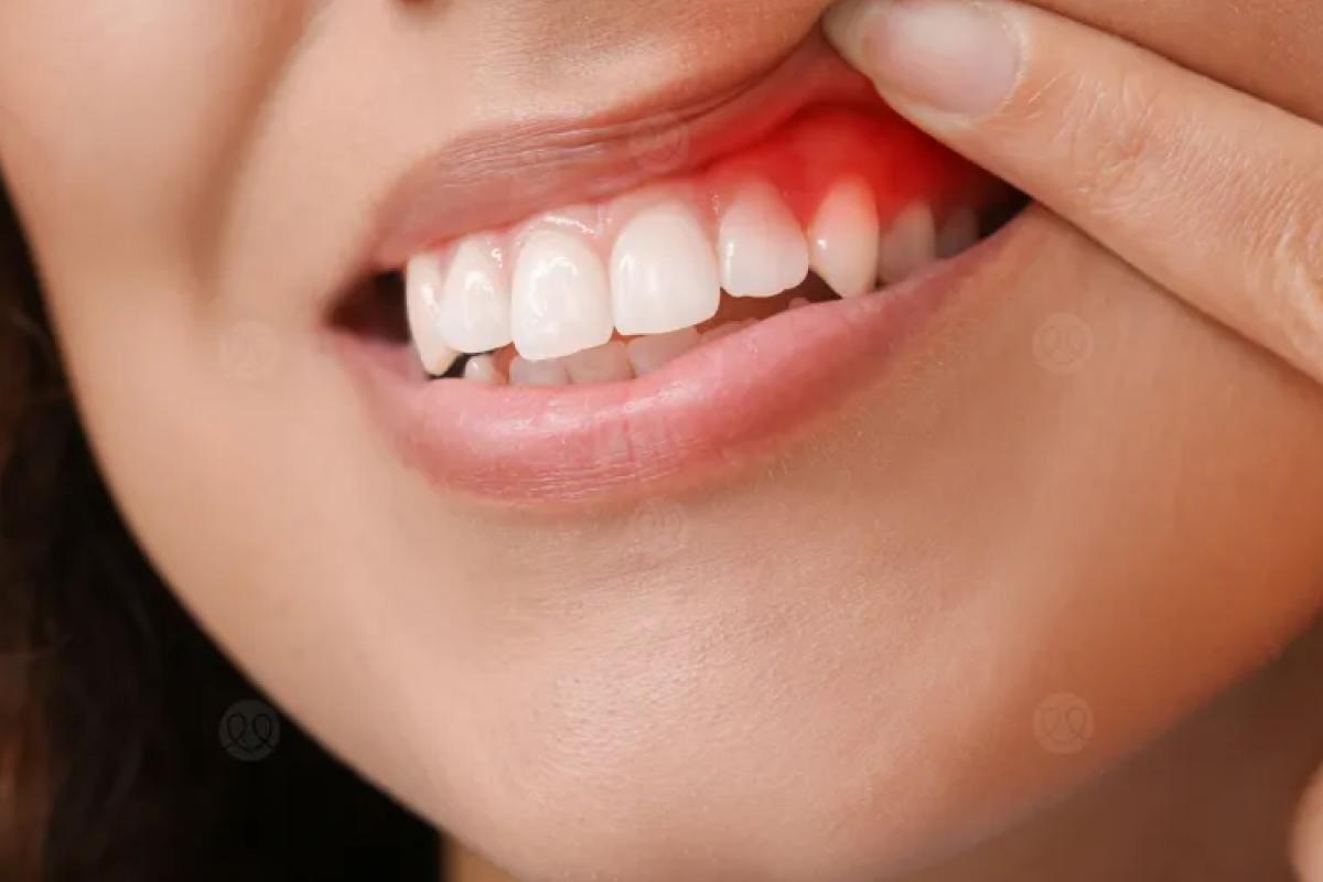 علاجات اللثة