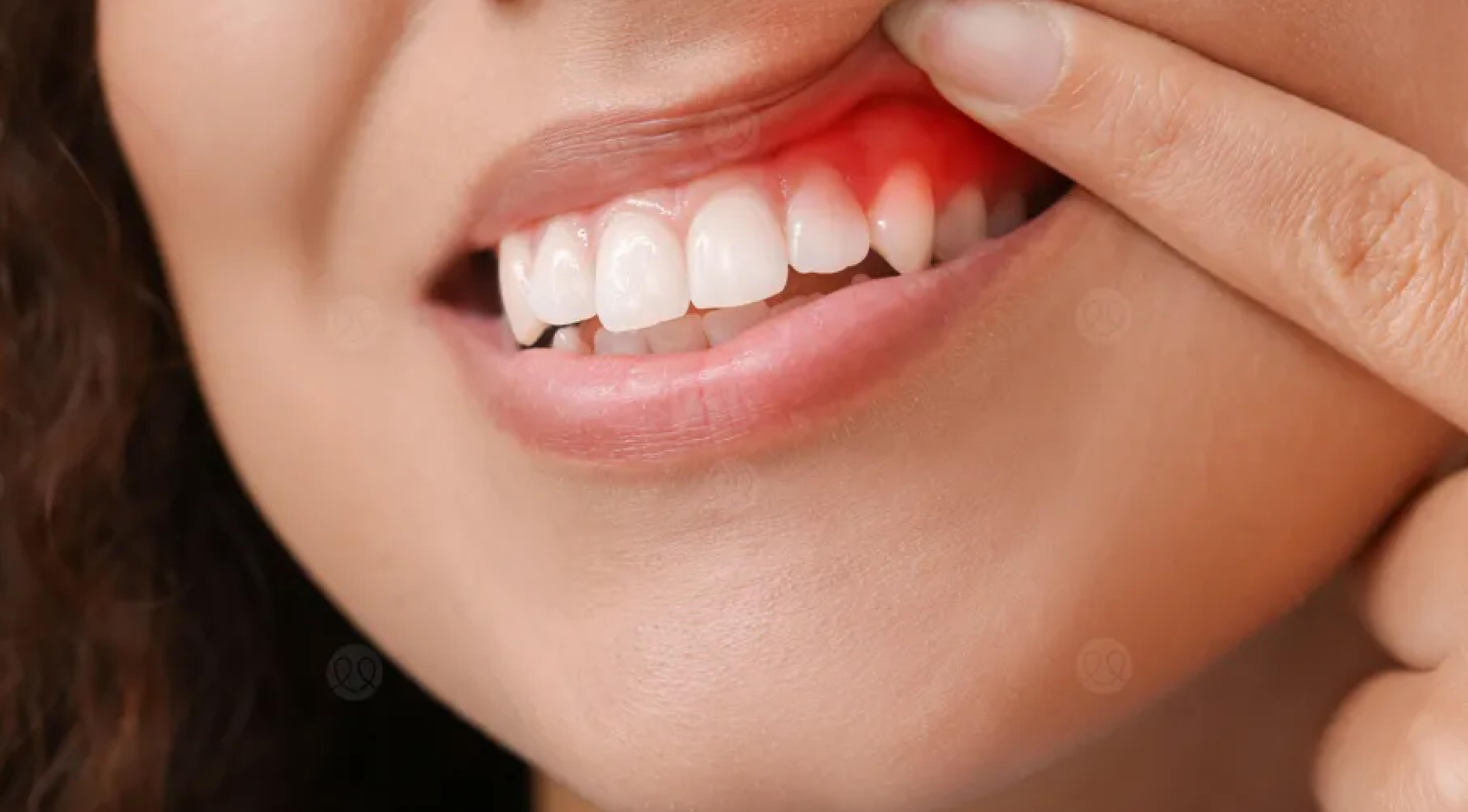 علاجات اللثة