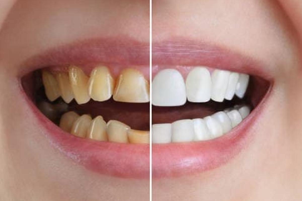 تجميل الأسنان