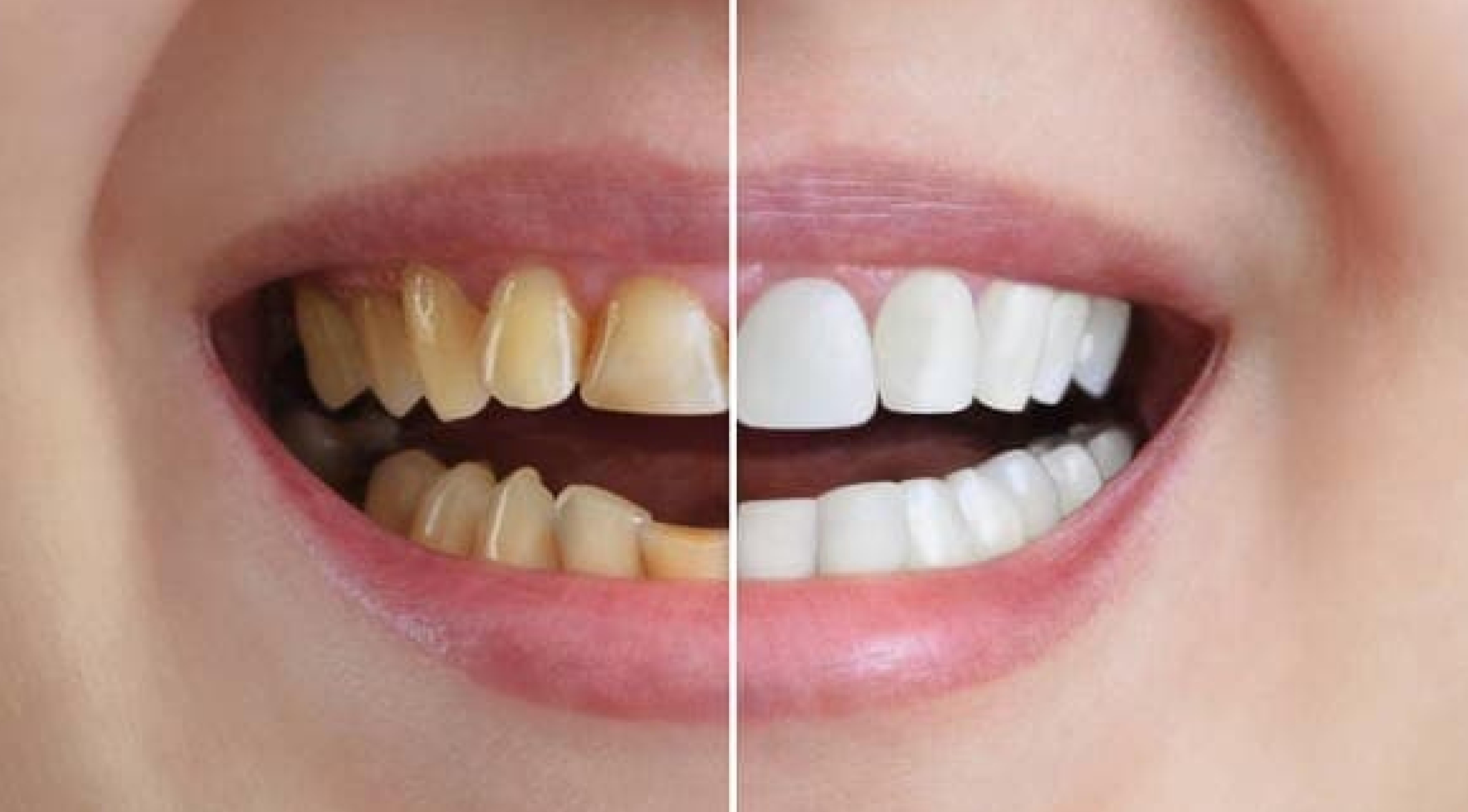 تجميل الأسنان