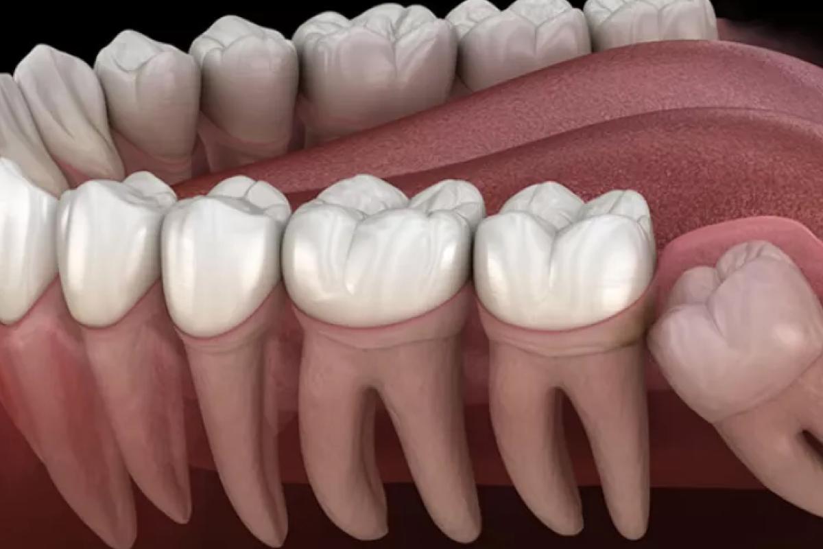 أضراس العقل