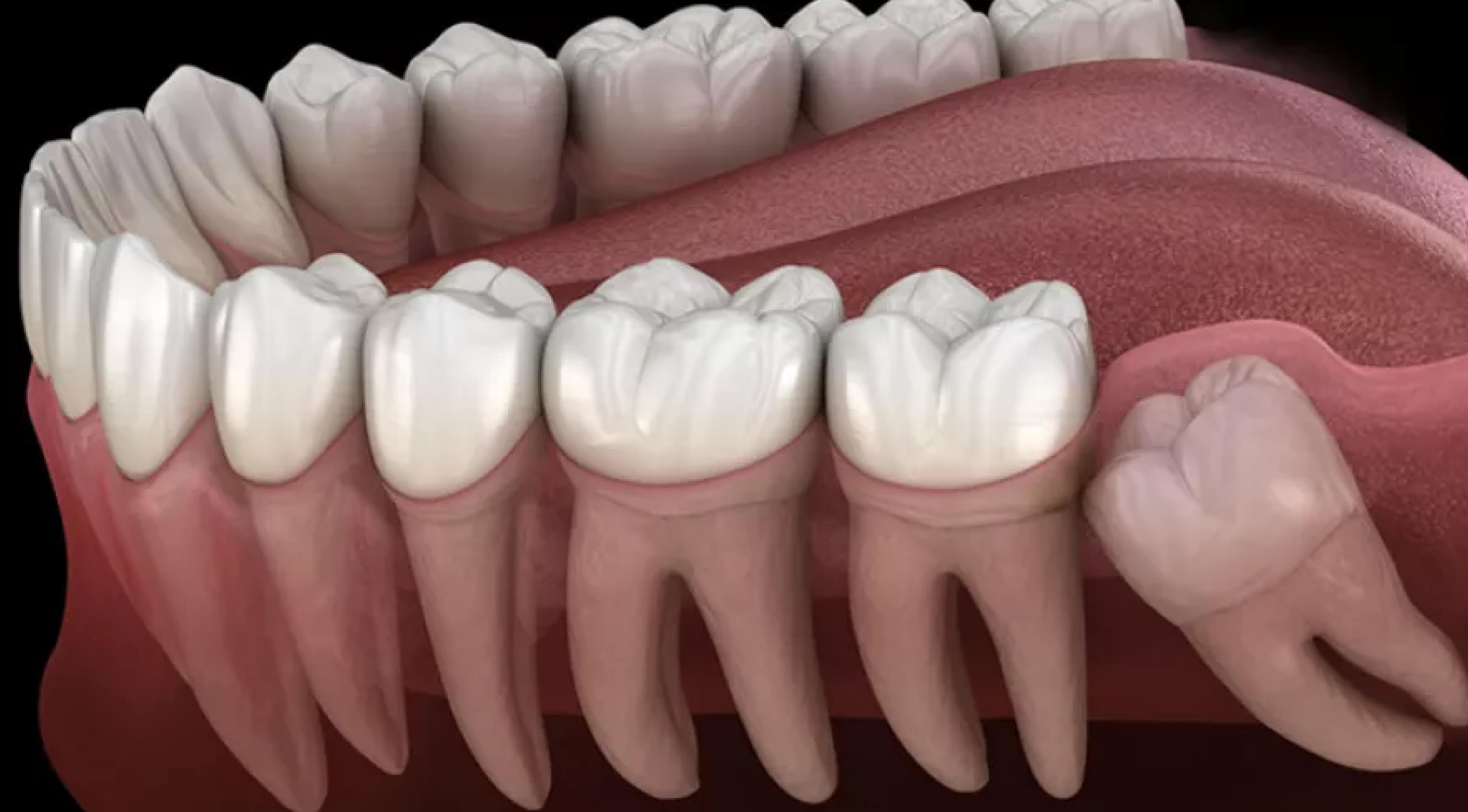 أضراس العقل