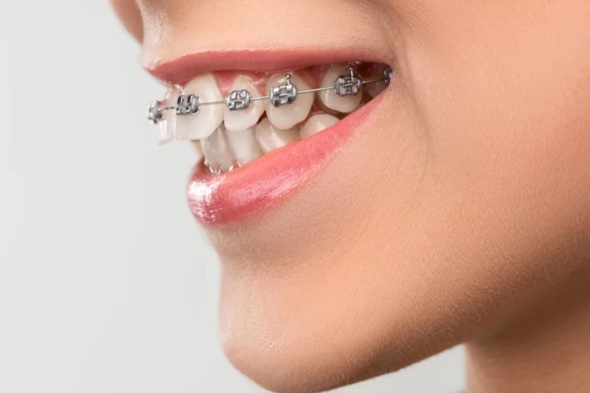 تقويم الأسنان والفكين