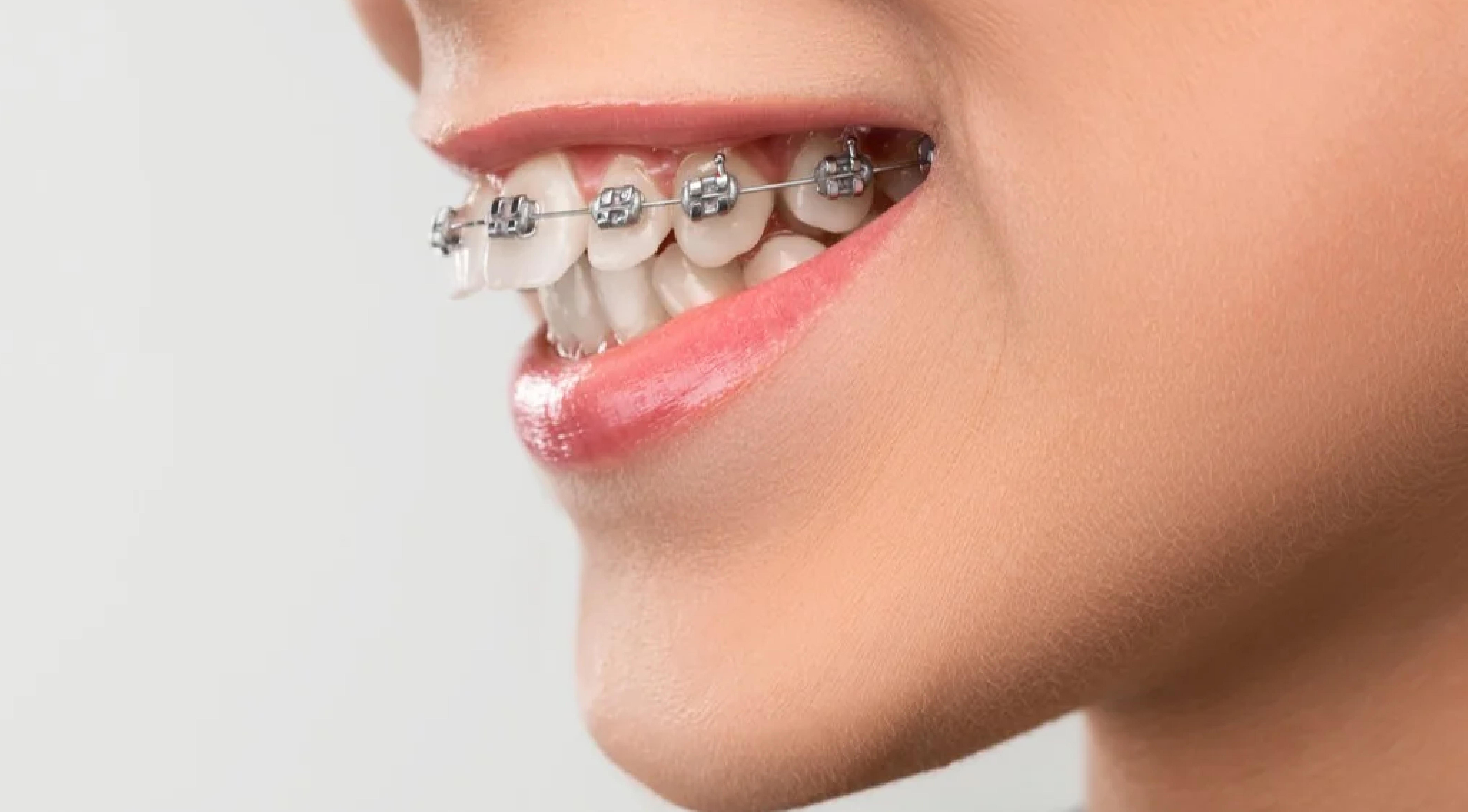 تقويم الأسنان والفكين