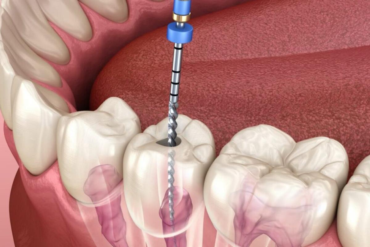 علاج عصب الأسنان